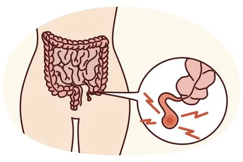 Closeup of human body with inflamed appendix. Person suffer from appendicitis 스톡 일러스트