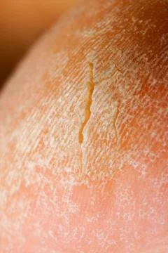 Closeup image of old callus with crack. Stock Photos