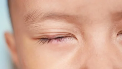 Closeup of Infected child eye patch with painful bump on lower eyelid. eye .. Stock Footage 232920380