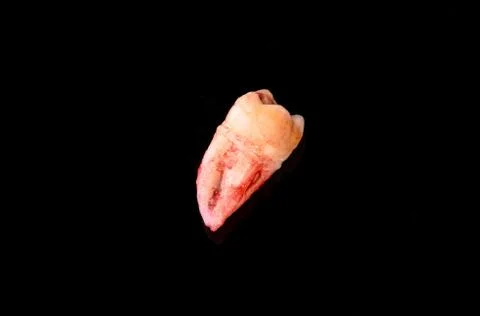 A closeup left upper third molar after extraction (Adult tooth number 28) Foto stock