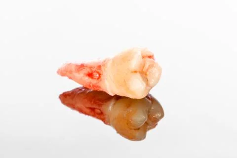 A closeup left upper third molar after extraction (Adult tooth number 28) Stock Photos