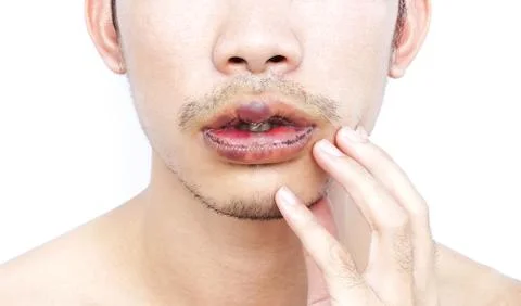 Closeup lips man upper and lower with reduction surgery, beauty concept Stock Photos