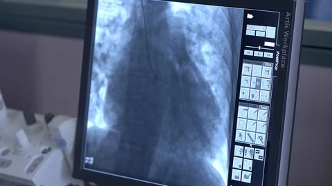 Closeup of live scanning screen during the surgical process Stock Footage 127612843