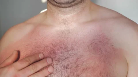Closeup man chest hand applying soothing balm cream Video stock 156500087