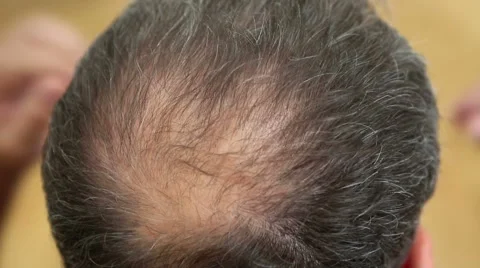 Closeup of man touching his balding head Stock Footage
