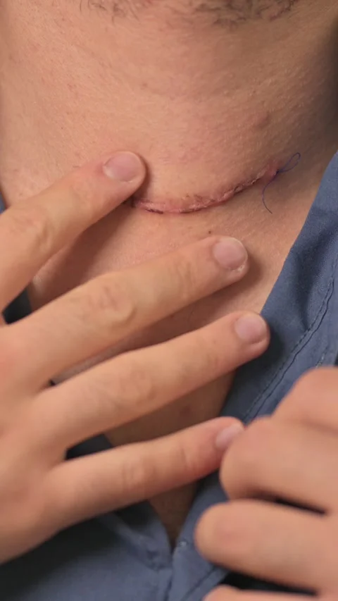 Closeup Of Man Touching a Neck Scar With Hand. 動画素材 335328251