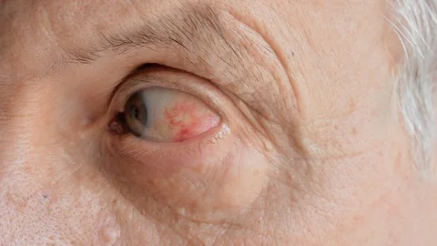 Closeup of old man with red eye inflammation caused by high blood pressure 库存影片 105570762