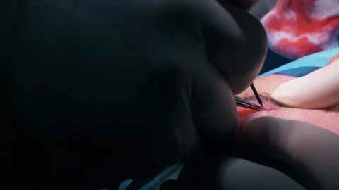 Closeup of plastic eyelid surgery. Stock Footage 278042150
