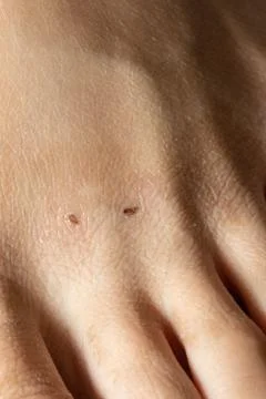 Closeup of scab on hand Stock-Fotos