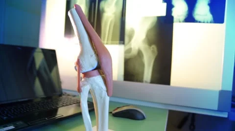Closeup scale model the layout of the artificial knee Stock Footage 64899367