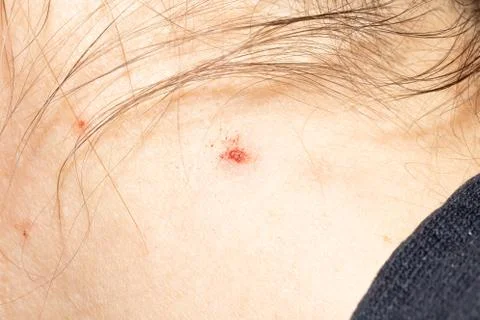 Closeup of scrape on woman's neck 스톡 사진