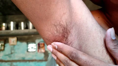 Armpit acne discount