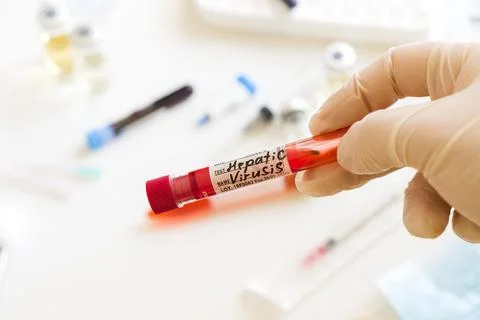 Closeup shot of a gloved hand holding a Hepatitis C blood test sample in a la Stock Photos