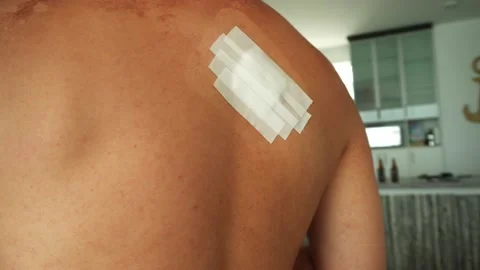 Closeup of a small operation on the back of a man healed with bandages and Stock Footage 172271200