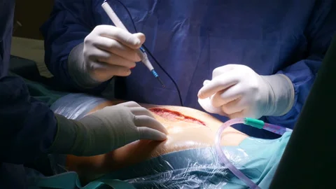 Closeup of surgeons performing incision during knee replacement operation Stock Footage 92315476