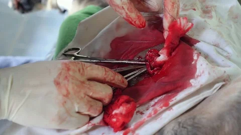 Closeup Surgery in Clinic Stock Footage 72005458