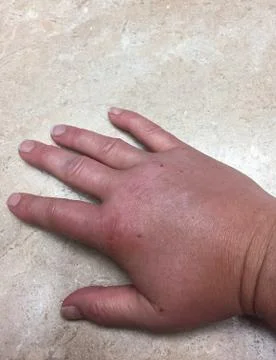 Closeup of swollen hand with bug bite and red skin Stock Photos