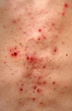 Closeup texture of a bad acne rash on a white male's chest. Stock Photos