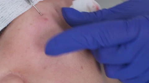 Closeup of thread lift injection in the cheeks Stock Footage 205141203