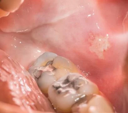 Closeup view of back tooth and sore, open mouth Stock Photos
