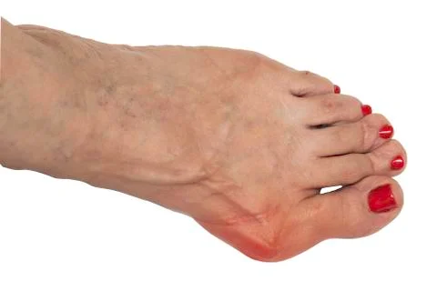 A closeup view on the bare foot of an elderly woman, showing a painful and sw 스톡 사진