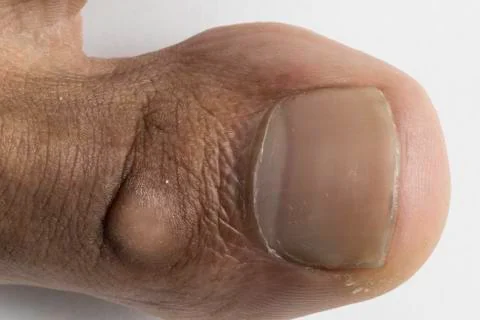 Closeup view of big toe with bump 스톡 사진