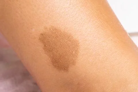 A closeup view of a large brown benign irregularity on the skin of a person,  스톡 사진