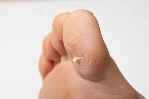Closeup view of a persons big toe with callus skin 스톡 사진