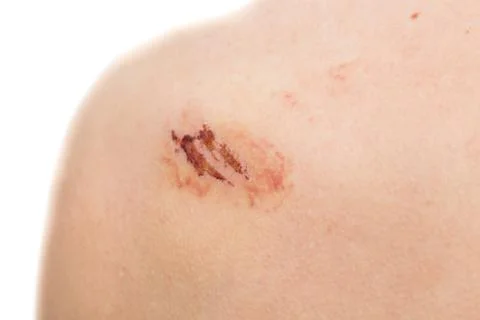 Closeup view of Scratch over left shoulder Stock Photos