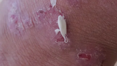 closeup weeping wounds, venous ulcers on... | Stock Video | Pond5