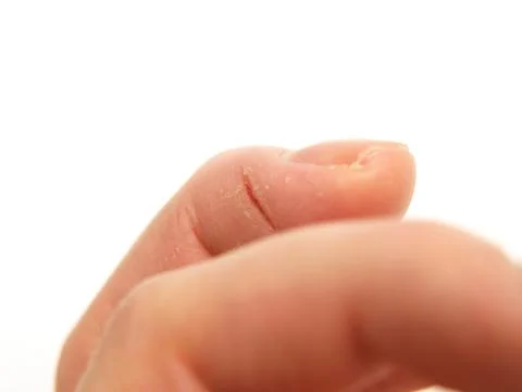 Closeup of wounded finger Stock Photos