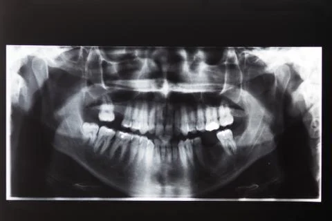 Closeup x-ray image of teeth and mouth Stock Photos