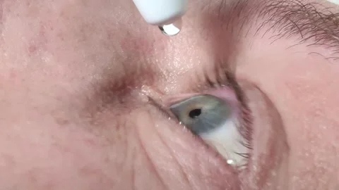 Closeup young man drops eye drops. Macro shot Stock Footage 271742413