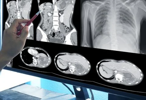 Clost up hand doctor point on computed tomography of the lungs with pneumonia Stock Photos