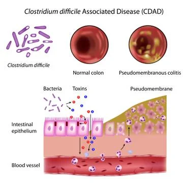 Clostridium difficile associated disease (cdad) Stock Illustration