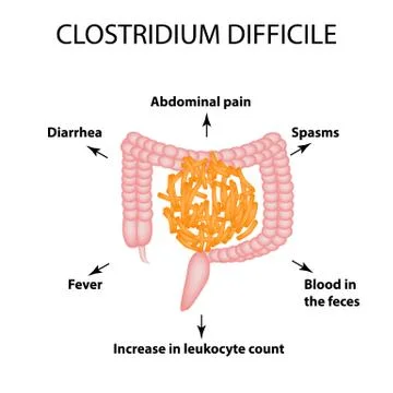 Clostridium difficile. Pathogenic flora. The bacterium causes intestinal Stock Illustration
