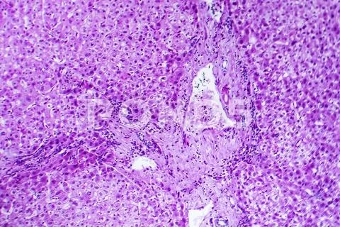 Cloudy swelling of the liver, light micrograph Stock Photo #115543545