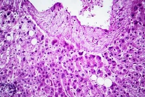 Cloudy swelling of the liver, light micrograph Stock Photos