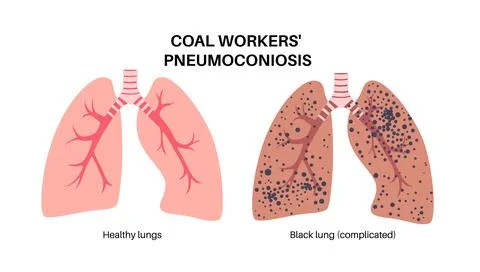 Coal workers disease Stock Illustration