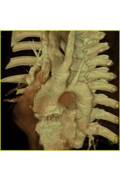  Coarctation of the aorta Aortic coarctation is a narrowing of the aorta, ... Stock Photos