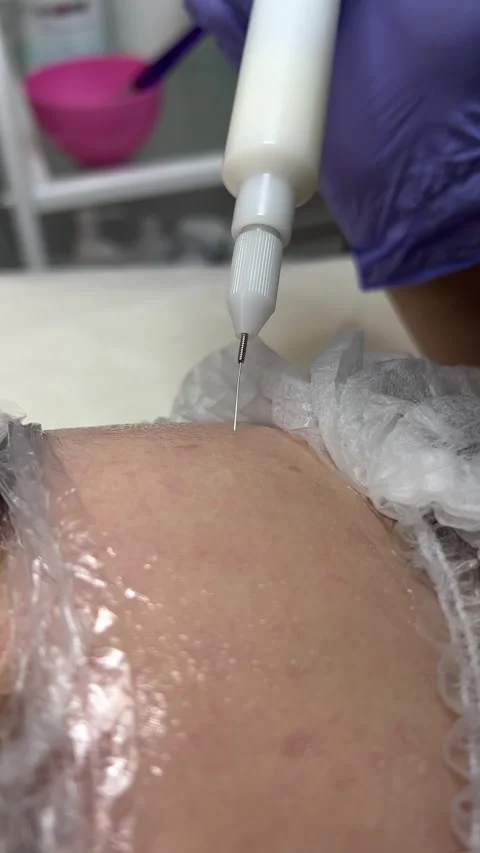 A cold plasma or non-equilibrium plasm for skincare. Removing dark spots Stock Footage 302161429