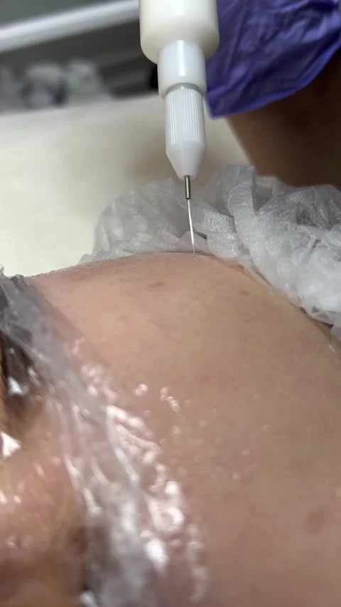 A cold plasma or non-equilibrium plasm for skincare. Removing dark spots Stock Footage 307284442