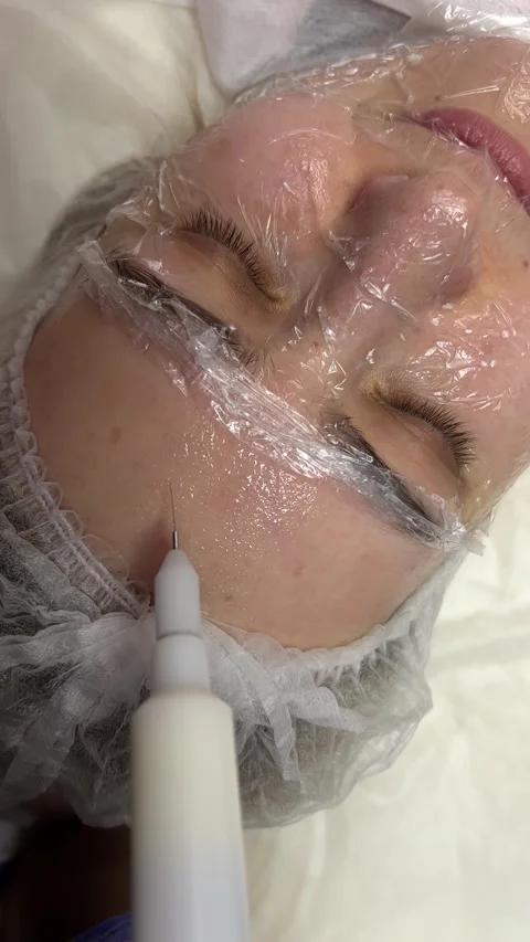 A cold plasma or non-equilibrium plasm for skincare. Removing dark spots Stock Footage 313109117