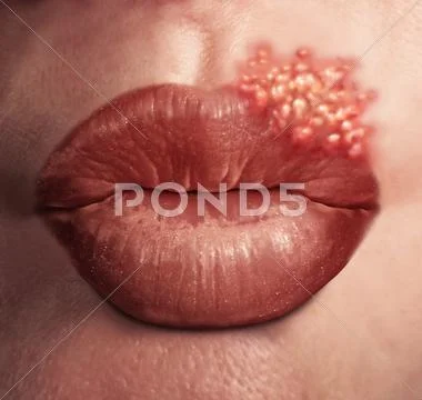 Cold Sore Virus Stock Illustration