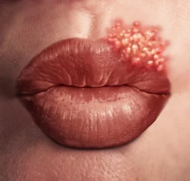 Cold Sore Virus 库存插图