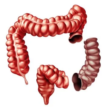 Colectomy Colon Surgery Stock Illustration