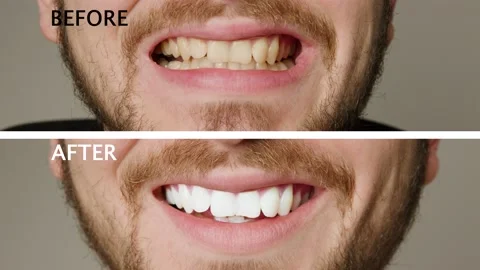 Collage of two superimposed pictures without background before and after with Video stock 232296396