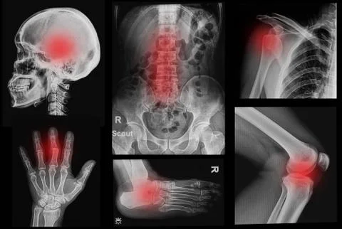 Collage  x-rays image of human ,show body part of human Stock Photos
