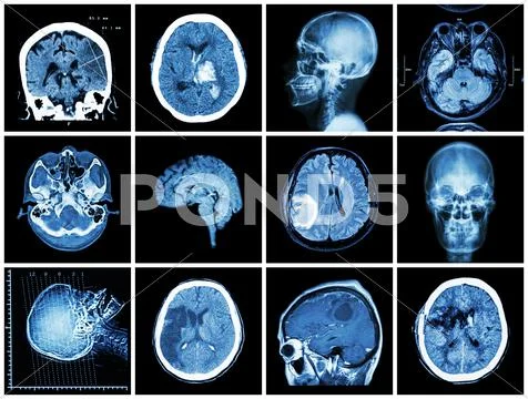 Collection Of Brain Disease ( Ct Scan And Mri Of Brain : Show Cerebral Infarc