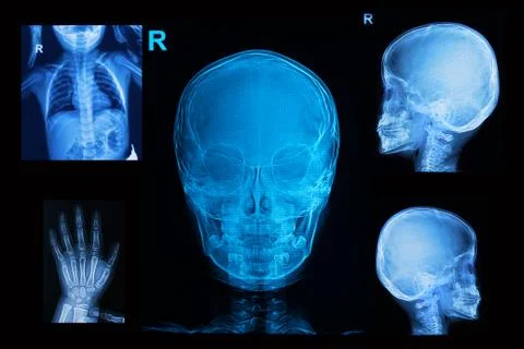 Collection of children x-rays  image show skull  chest and hand image Stock Photos